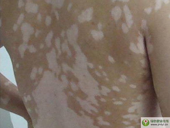 白斑.png 白斑.png